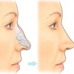 Nose Surgery in Islamabad